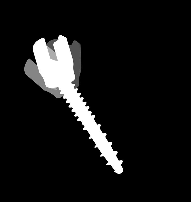 The screws contain six fenestrations near the distal tip of the screw which provides a controlled means to deliver a small amount of polymethylmethacrylate (PMMA) bone cement into a targeted