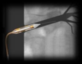 Over-the-wire balloon with RF electrodes Enhanced patient safety and efficacy CE