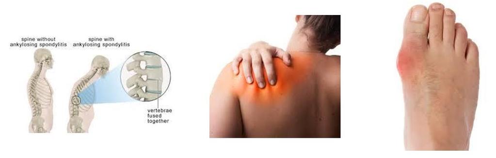 osteoarthritis, acute painful shoulder (bursitis and/or