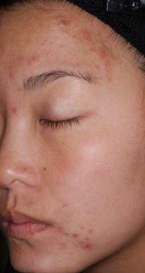 Visonac Treatment of Patients with Moderate to Severe Acne Acne is an attractive market Impacts 85% of all 12-24 year olds High unmet need for moderate to severe acne avoid antibiotic resistance,